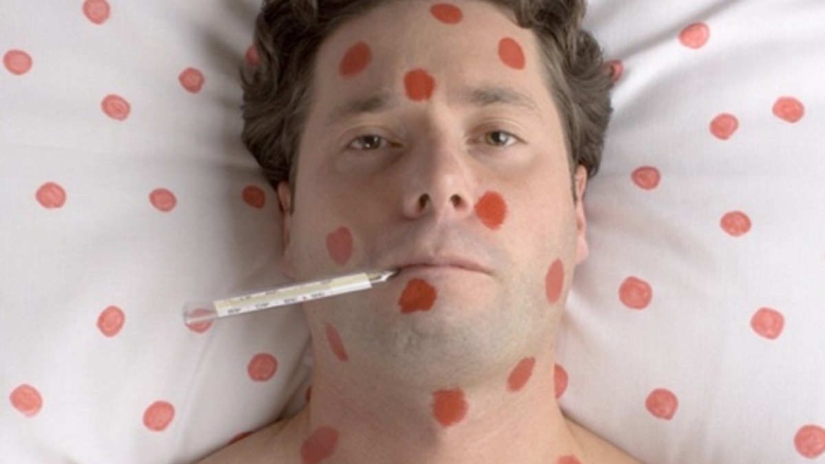 С начала года корью заболели более 47 тысяч украинцев