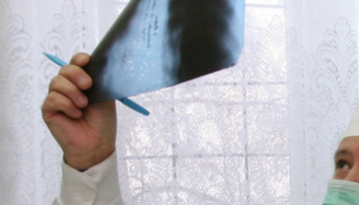 Мать, по вине которой, ребенок заболел туберкулезом, будут судить