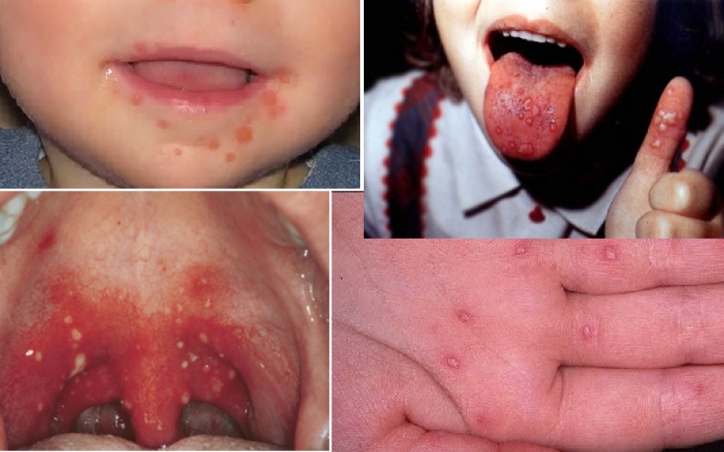 На Днепропетровщину пришел опасный вирус Коксаки 