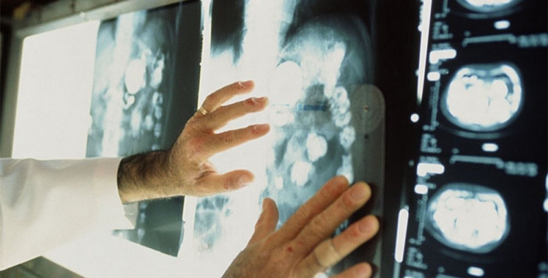 55 павлоградцев отказались от лечения рака из-за нехватки средств