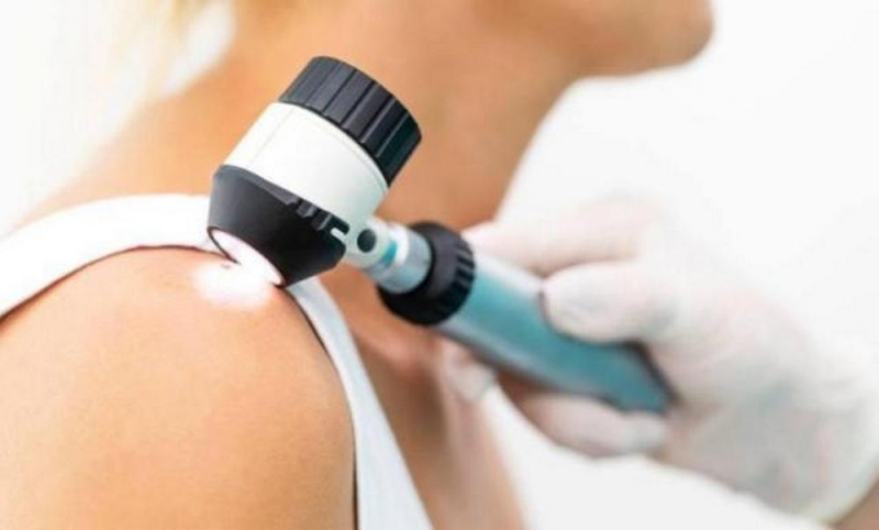 Врачи Павлограда предупредили горожан об онкологической опасности родимых пятен