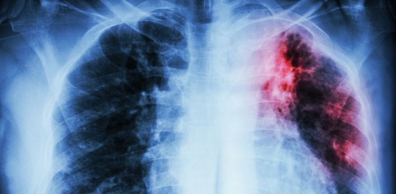 В этом году в Павлограде обнаружили 35 новых случаев туберкулеза. Эпидемия продолжается