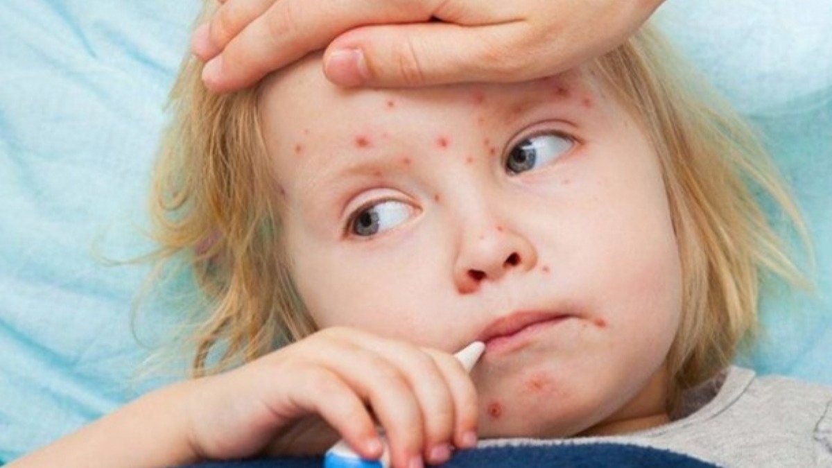 В 2019 году корью заболели более 300 жителей Днепропетровщины