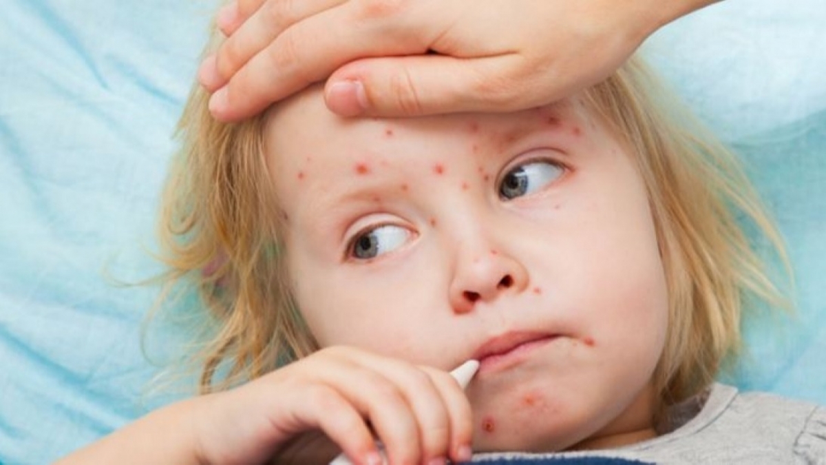 От кори с начала года умерло 10 человек. Количество заболевших уменьшается - MOЗ