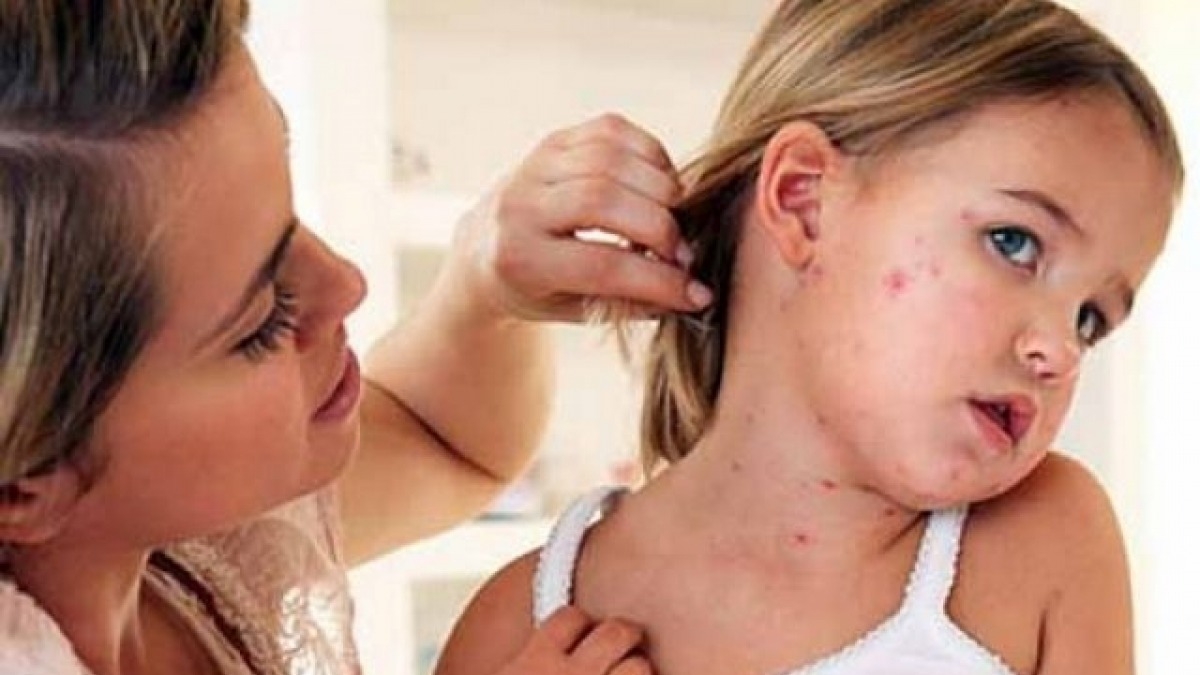 С начала года корью заболели более 30 тысяч человек, 11 умерли